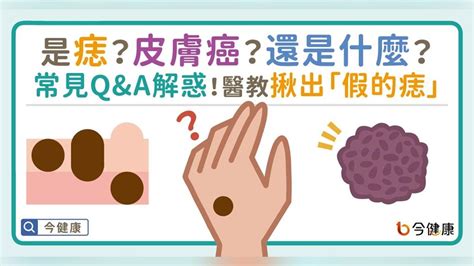 右下巴痣長毛|是痣？皮膚癌？還是什麼？常見Q&A解惑！醫教揪出「。